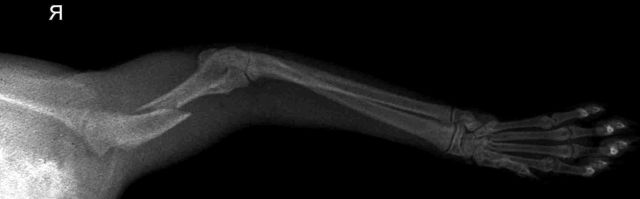 Рентгеновский снимок перелома